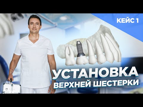 КОРОНКИ ИЗ МЕТАЛЛОКЕРАМИКИ В КИРОВЕ / Центр имплантации Диэлит