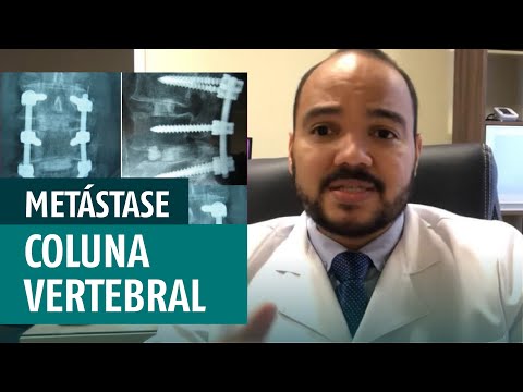 Vídeo: Metástases De Câncer Na Coluna (vértebra)