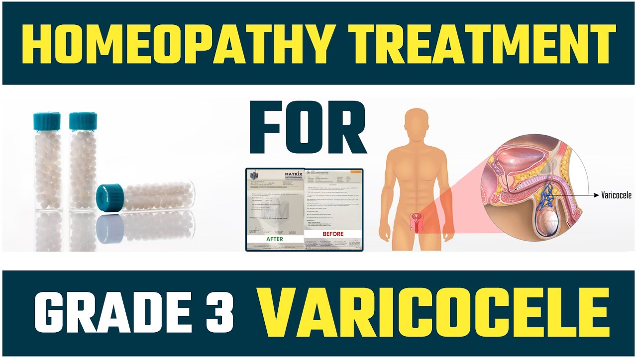 What is a varicocele and its Diagnosis by Homeopathy