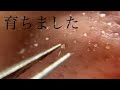 角栓収穫！今日もでかい！