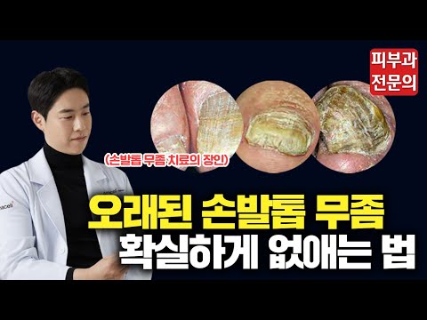<strong>발톱무좀</strong> 부작용 없이 안전하게 치료하기(오가나셀 피부과의원)