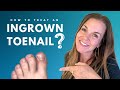 How To Treat An Ingrown Toenail