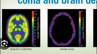 Difference between Brain Death/Coma/Clinical Death