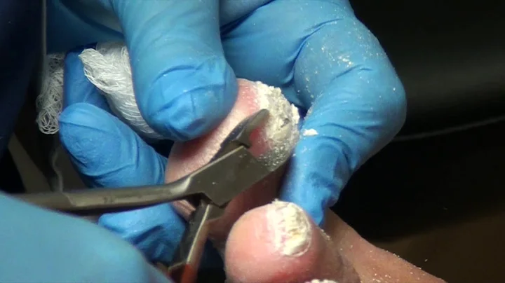 Trimming really thick nails on patient with Cerebr...