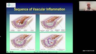 The Role of Inflammation and Its Management in Cardiometabolic Disease