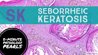 Seborrheic Keratosis: 5Minute Pathology Pearls