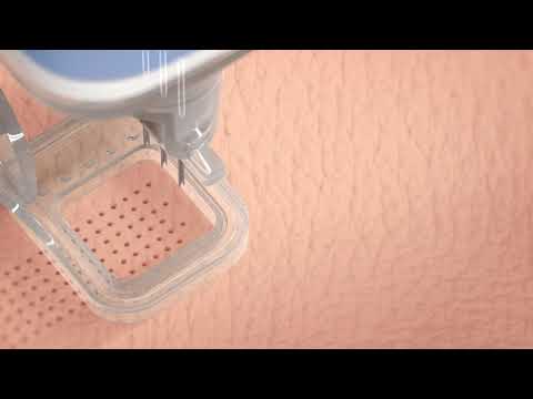 Ellacor Micro-coring Treatment at Faces+