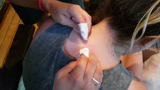 Blackhead in Balga Blackhead in Balga