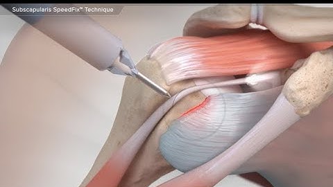 Subscapularis SpeedFix™ Technique