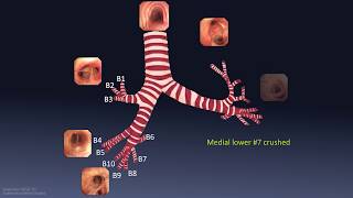 Mastering Bronchoscopy for Thoracic Surgery: Chapter 1