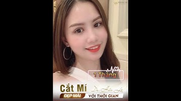 Review từ A-Z hành trình mí mắt sau 2 năm Cắt mí tại Dr.Hải Lê cơ sở HCM
