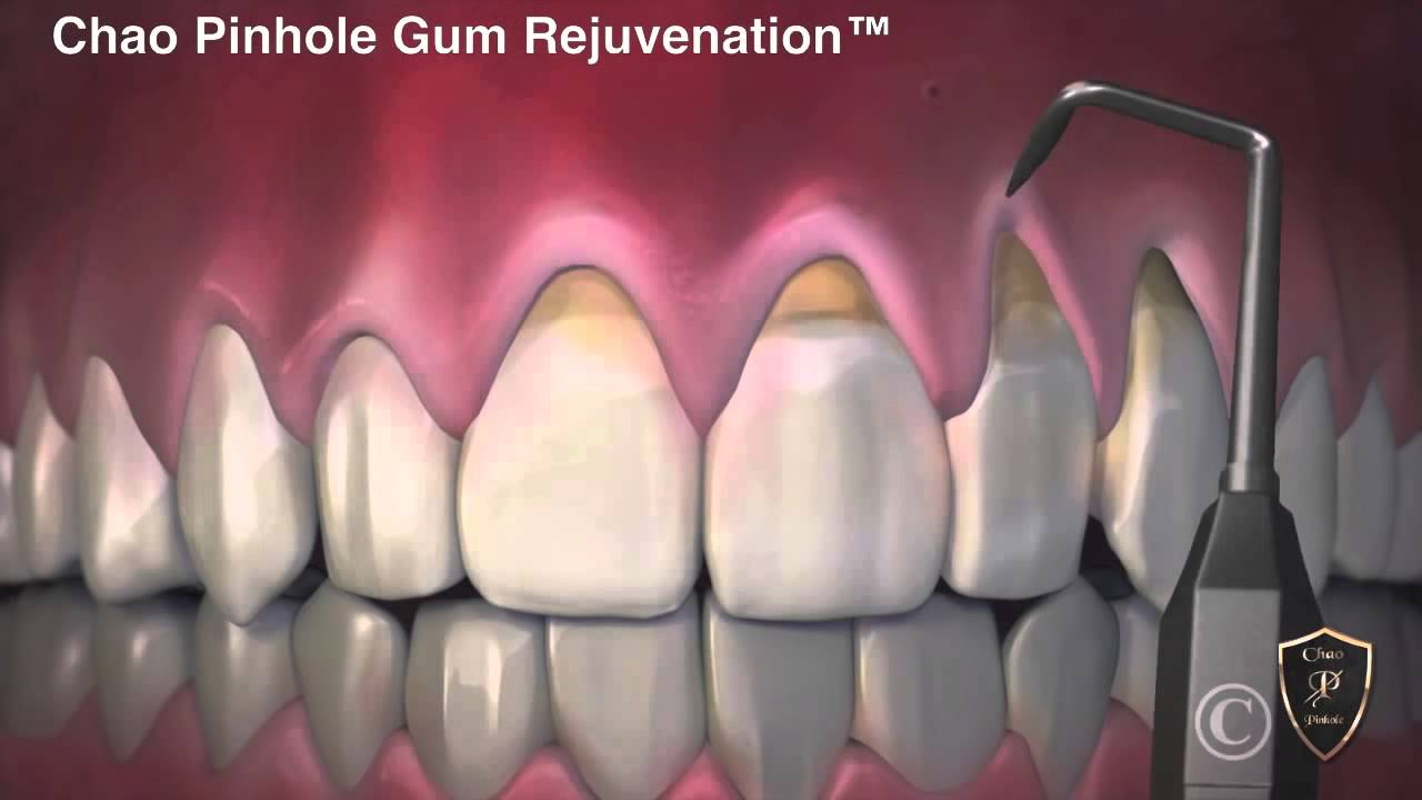 Conventional Gum Grafting vs Chao Pinhole Surgical Technique Female