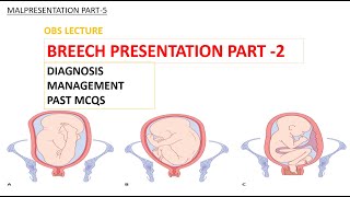 BREECH PRESENTATION PART-2| DIAGNOSIS | ECV | VAGINAL BREECH DELIVERY | MCQS| MALPRESENTATION PART 5