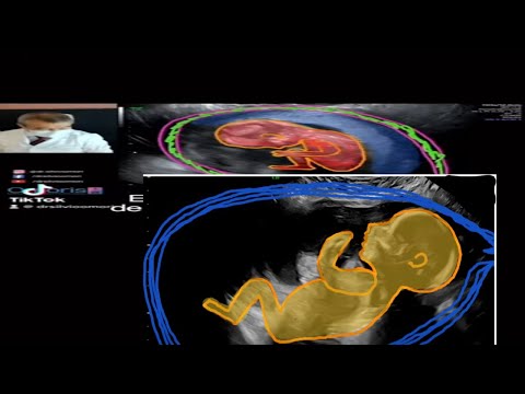 Gravidez 13 semanas #gestante #gravidez #ultrassom #gestacao #bebe