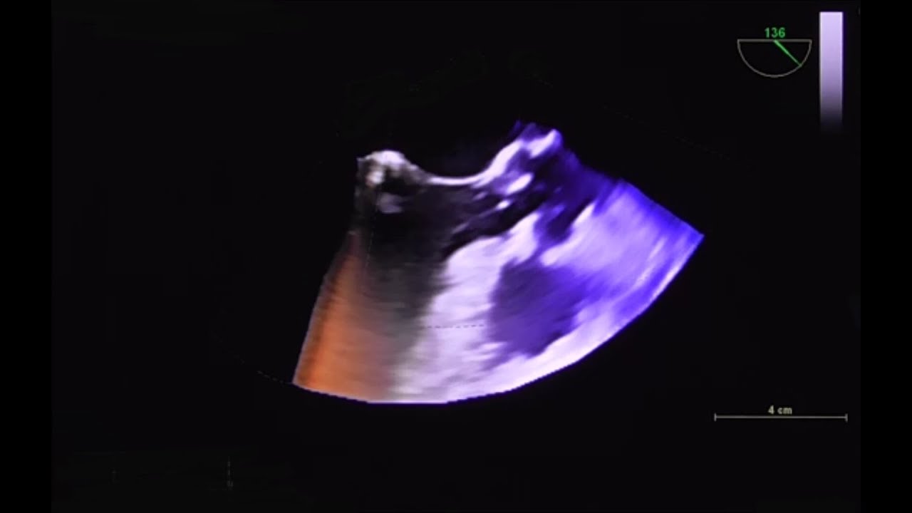 Aberrantly inserted chordae tendineae