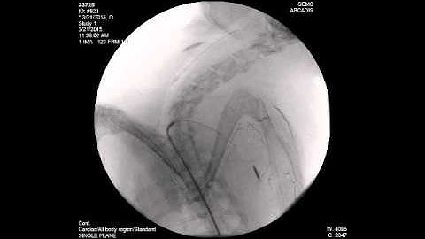 Biodegradable shape memory embolization: Animal test
