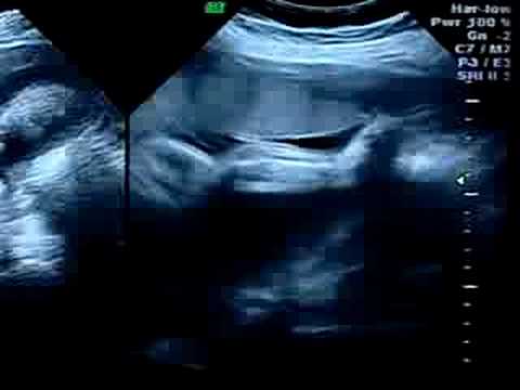 Ultrasound 31 Weeks