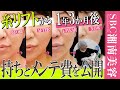 【アラフォーたるみ整形密着】糸リフト1年3か月後でどこまでキープできた?メンテ費は?リアルな経年変化をお見せします【ほうれい線とたるみ治療の現実】湘南美容クリニック