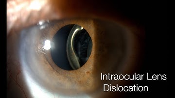 Yamane Technique | Intraocular Lens Dislocation | IOL Exchange | Tijuana, Mexico