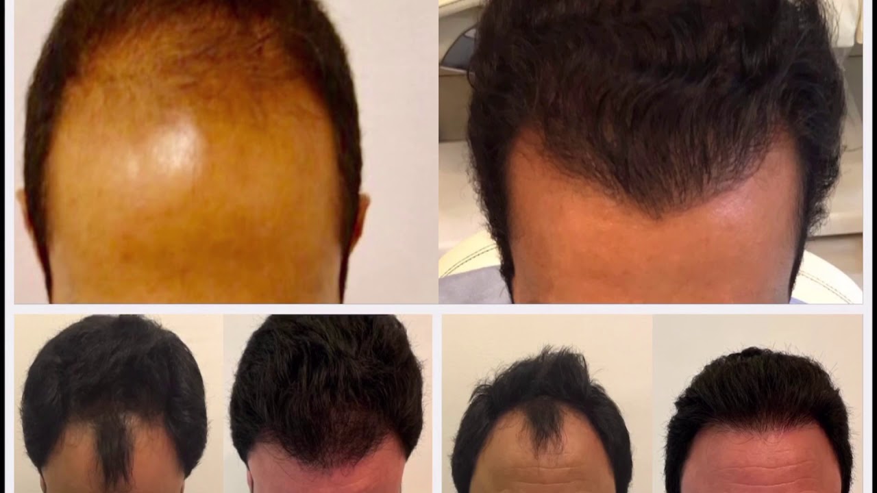 عمليات زرع الشعر و 6 إجراءات ما قبل وبعد