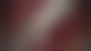 Thoracoscopic Sublobar Resection for Pulmonary Sequestration