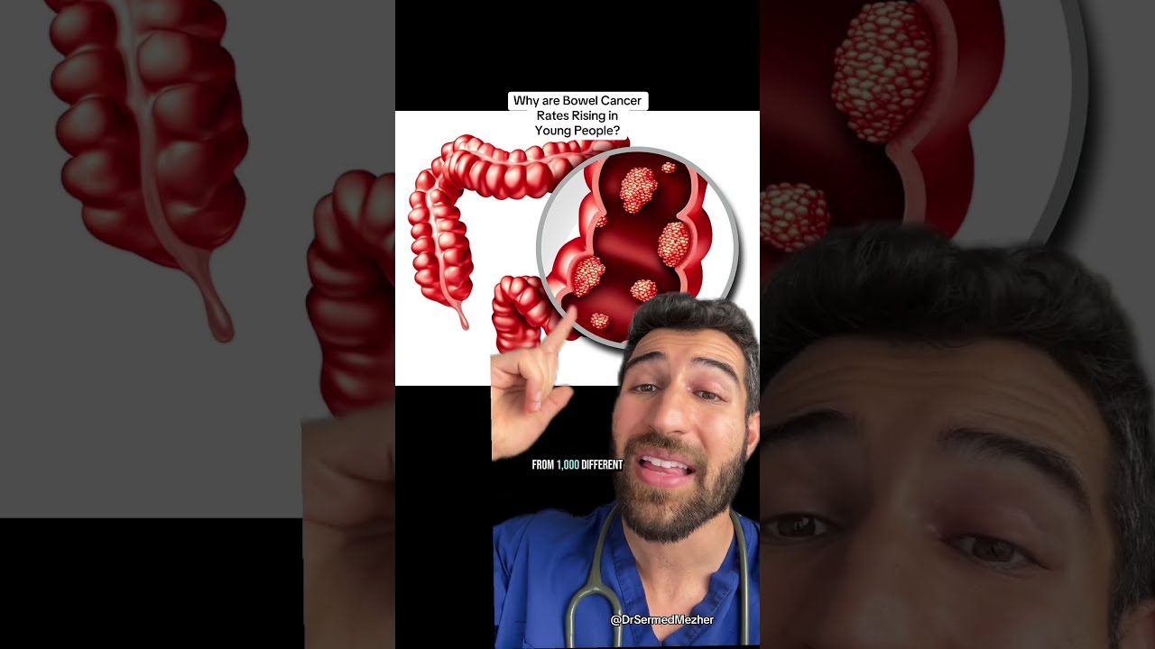 Why Are Bowel Cancer Rates Rising In Young People Breakthrough