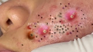 Extreme Blackhead Removal at LNG Skin Care 7214