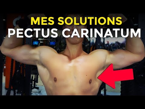 PECTUS CARINATUM OU THORAX BRECHET : LA SOLUTION EN MUSCULATION
