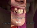 تقويم الاسنان لتعديل الناب العلوي Dr Abdullah Sultan Dentist دكتور عبدالله سلطان الهنداوي 