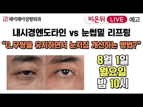 [비온뒤] 무쌍을 유지하면서 눈처짐을 개선하는 방법? 생방송 예고 - 제이제이성형외과
