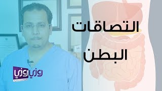 ما هي التصاقات البطن