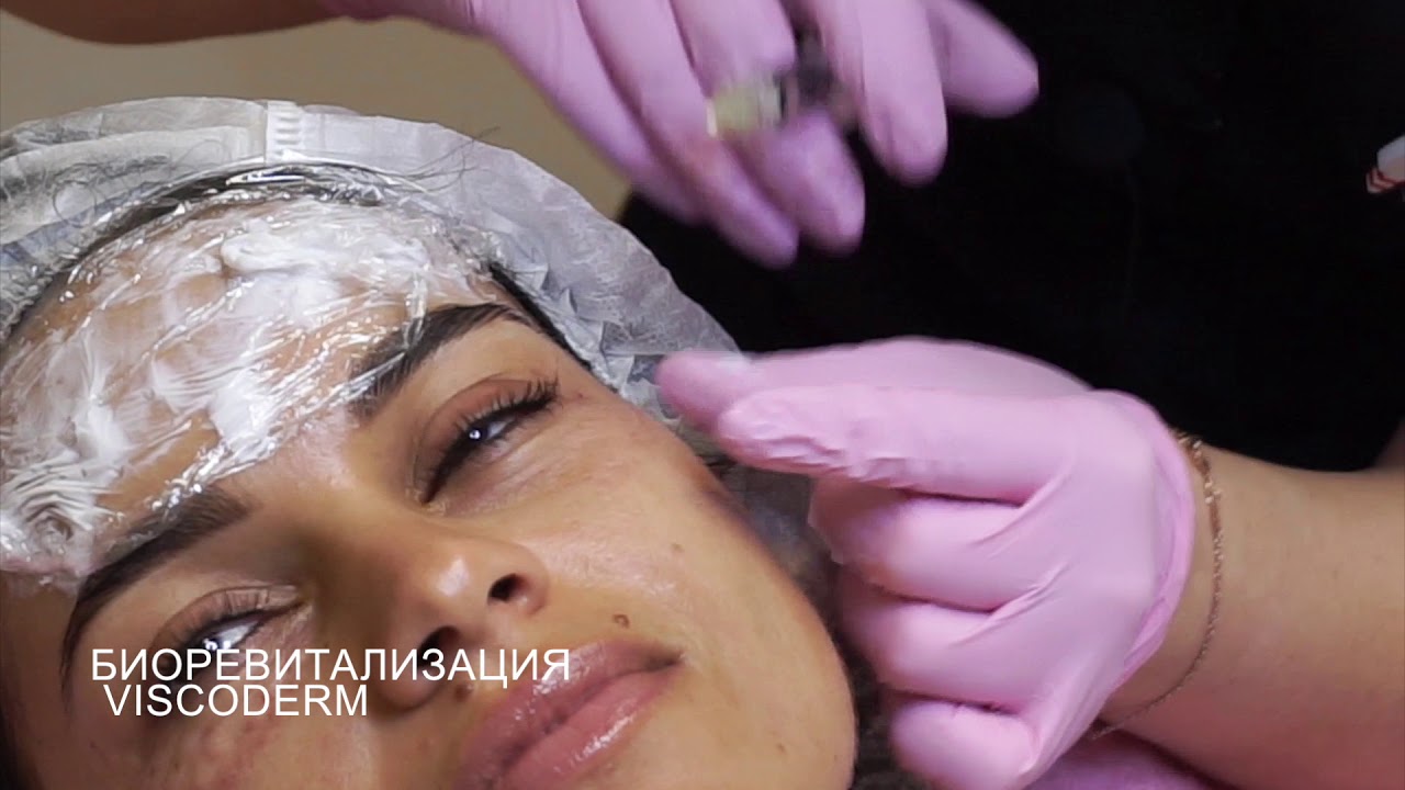 Биоревитализация Viscoderm 0,8