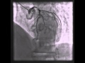 DANG VAN CHAU, 1940, COROGRAM, hẹp khít thân chung và 3 nhánh động mạch vành