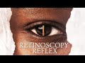 Retinoscopy : Reflex and it's characteristics |Optometry| Opthalmology