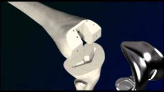 Total Knee Animation.mpeg