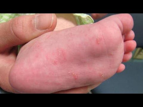 Video: Теринин кычышуусу бекерчиликке аллергия болуп саналат