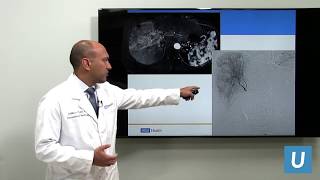 Minimally Invasive Treatment for Liver Cancer | Sid Padia, MD | UCLAMDChat