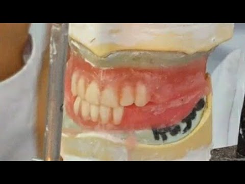 setting of lower anterior teeth بالعربي