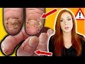 BREAKING NEWS - NAIL ALLERGIES, YOUR SERIOUS RISKS & HOW TO STOP THEM