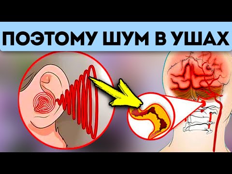 О чём предупреждает звон и шум в ушах? Что делать, если возникает шум в ушах?