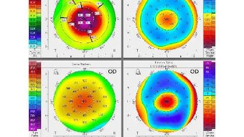 Not Narrated: Epithelial imaging in refractive and cataract surgery ASCRS 2015
