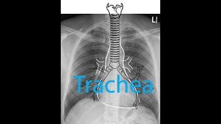 Chest x ray - Part 2 -Trachea -- Normal Anatomy