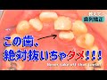 【歯列矯正】でこぼこ前歯、抜歯確定！？いいえ、抜きません！