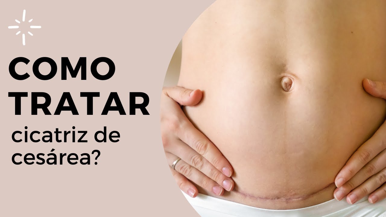 Fitas de Silicone para Cicatriz de Cesárea | O MELHOR TRATAMENTO para ...