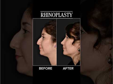 Video thumbnail: Life Changing Rhinoplasty · Rady Rahban, MD