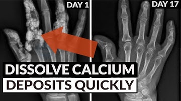 Reverse Soft Tissue Calcification: Bring Calcium Out Of Tissue & Into Bones