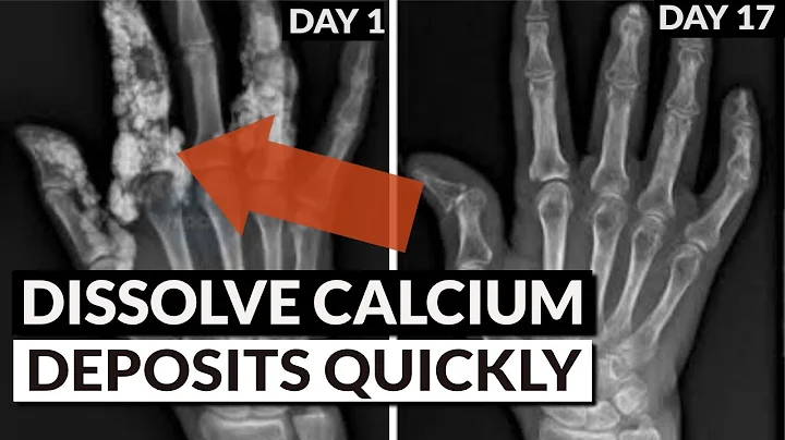 Reverse Soft Tissue Calcification: Bring Calcium Out Of Tissue & Into Bones
