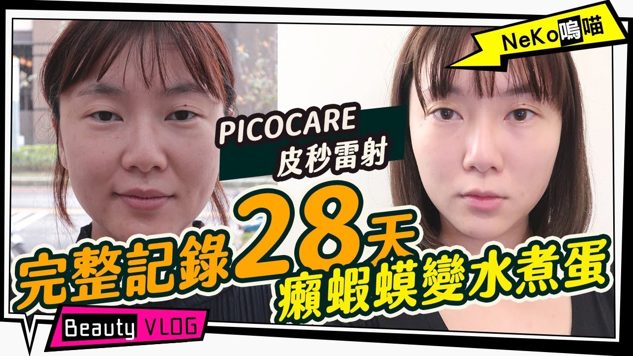 皮秒雷射picocare不一樣 痘疤凹洞毛孔連黑眼圈都一併擊碎了 28天完整記錄 Neko嗚喵 醫美 Youtube 皮秒雷射picocare不一樣 痘疤凹洞毛孔連黑眼圈都一併擊碎了 28天完整記錄 Neko嗚喵 醫美 Youtube