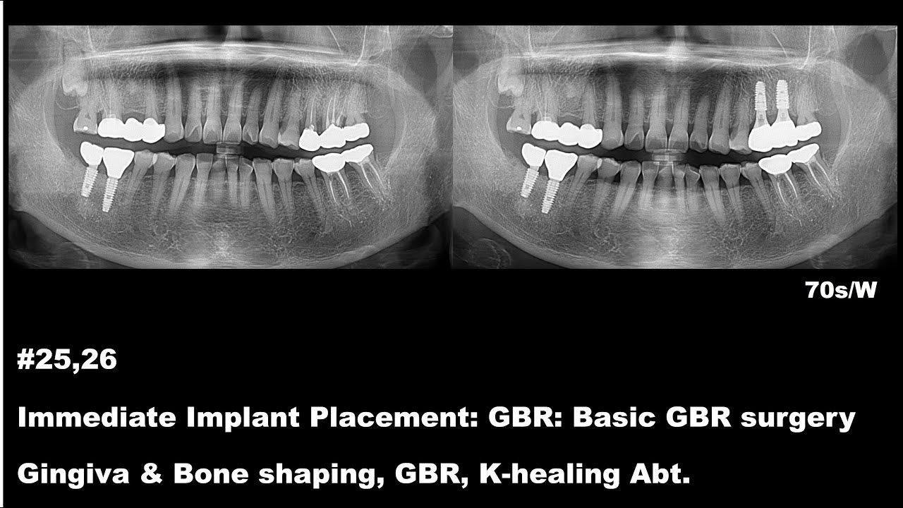 [Dental implant] #25, 26 Immediate Implant Placement: GBR: Basic GBR ...