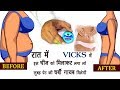 Vicks में ये मिलाकर लगाए पेट की चर्बी को बर्फ की तरह पिघलाये How to Lose Belly Fat in 1 Week